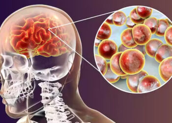Tarija en alerta tras confirmarse dos casos de meningitis