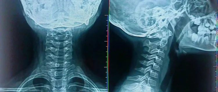 Los ligamentos del cuello fueron dañados