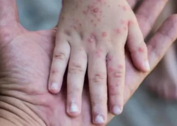 Alcaldía de La Paz activa vigilancia epidemiológica ante casos de sarampión