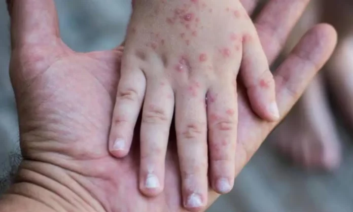 Alcaldía de La Paz activa vigilancia epidemiológica ante casos de sarampión