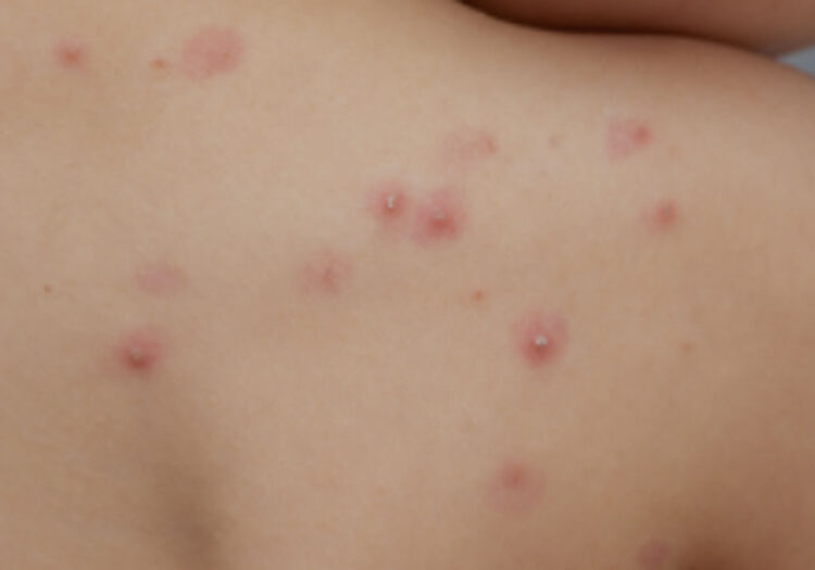 OMS descarta por ahora temores de una pandemia por la viruela del mono