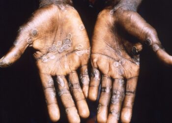 Las manos de una persona portadora del virus de la viruela del mono. Foto: Archivo LR