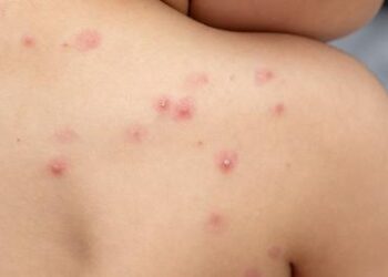 Chile decreta alerta sanitaria tras confirmar seis casos de viruela del mono