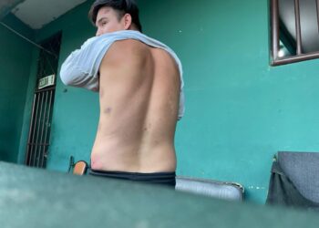 Anderson Lijerón mostró sus hematomas causadas durante su detención en La Guardia. Foto: UJT