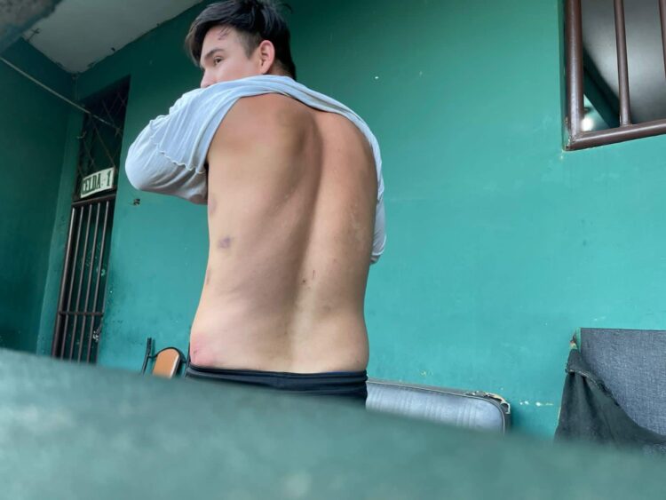 Anderson Lijerón mostró sus hematomas causadas durante su detención en La Guardia. Foto: UJT