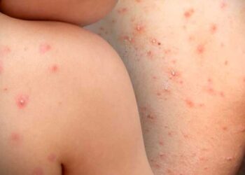 Brotes de la viruela de mono. Foto: AFP.