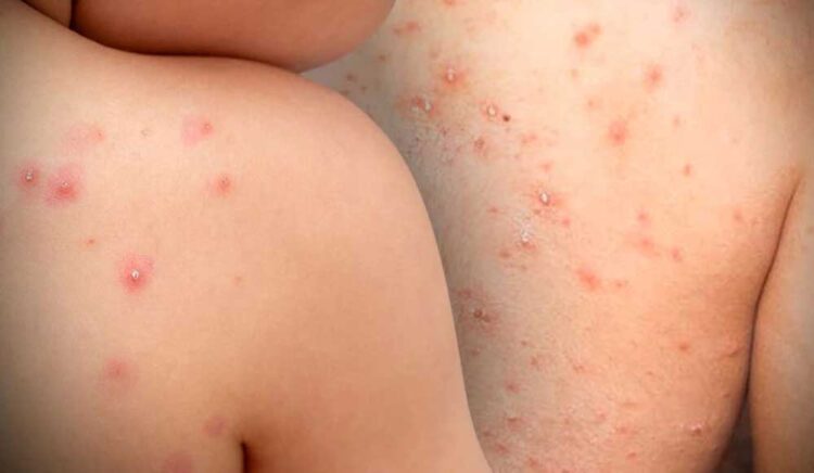 Brotes de la viruela de mono. Foto: AFP.