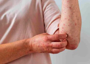 Cinco nuevos casos de viruela del mono, ya hay 134 en el país