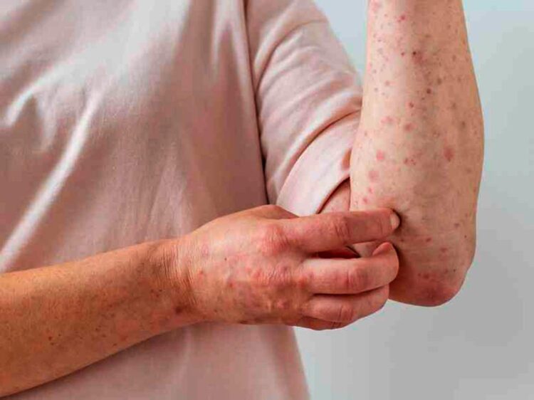 Cinco nuevos casos de viruela del mono, ya hay 134 en el país