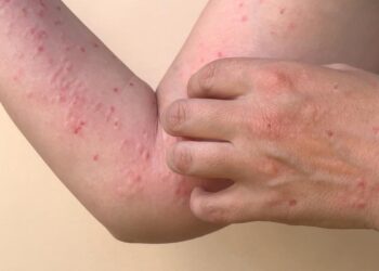 Salud de un paciente con viruela del mono se complica y requiere hospitalización