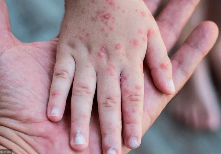 Con cuatro nuevos casos de la viruela del mono, el número sube a 10, todos en Santa Cruz