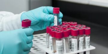 Japón autoriza una prueba sanguínea para detectar el Alzheimer.