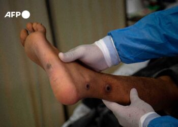 Epidemia_viruela_del_mono_retrocede pero_no_desaparecio.jpg