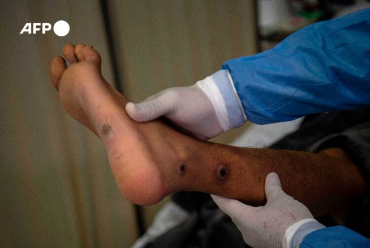 Epidemia_viruela_del_mono_retrocede pero_no_desaparecio.jpg