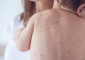 Sedes Pando declara alerta roja por el sarampión