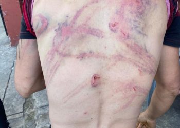 La espalda lacerada del albañil que recibió una golpiza por una confusión.