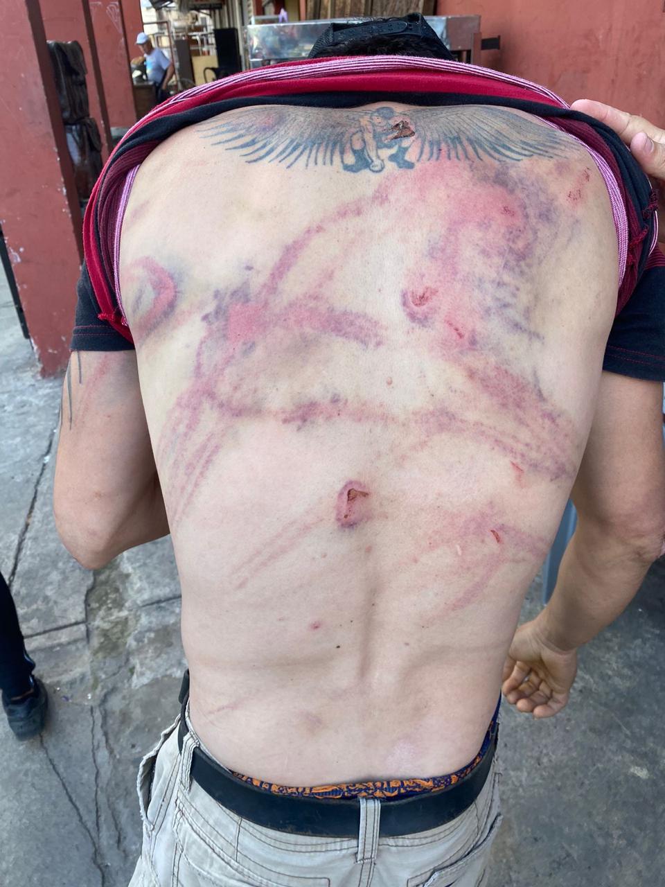 La espalda lacerada del albañil que recibió una golpiza por una confusión.