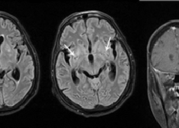 meningitis fúngica