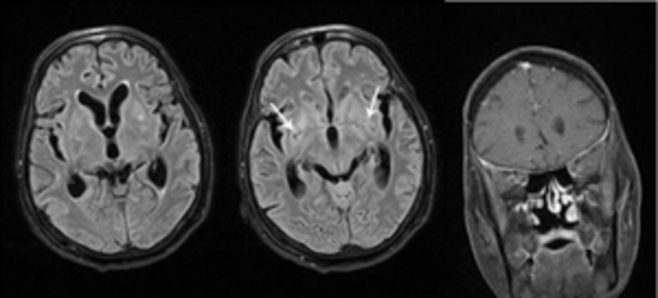 meningitis fúngica